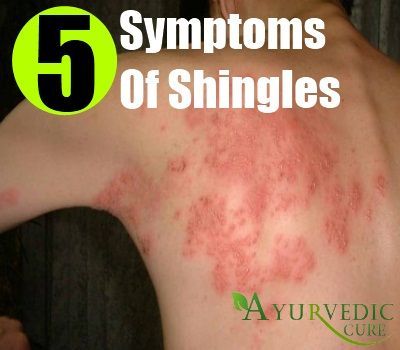 Shingles Symptoms Signs, Rash On Stomach, Signs Of Shingles, Shingles Symptoms, Shingles Pain Relief, Shingles Remedies, Shingles Relief, Shingles Rash, Lymph Node