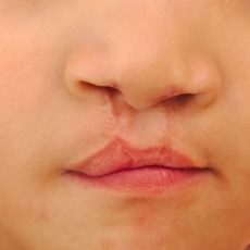 Arm Lift Surgery, Lip Surgery, Forehead Lift, Cleft Lip And Palate, Cleft Palate, Cleft Lip, Lip Drawing, Reduction Surgery, Baby Lips