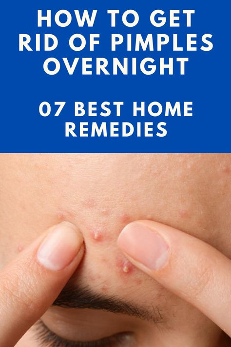 Face Pimples Remedies, Remove Pimples Overnight, Get Rid Of Pimples Overnight, Rid Of Pimples Overnight, Home Remedies For Pimples, Blind Pimple, Get Rid Of Pimples, Rid Of Pimples, Pimples Under The Skin