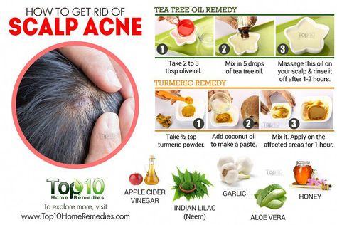 Pimples On Scalp, Scalp Acne, Chest Acne, Forehead Acne, Natural Acne Remedies, Natural Acne, Home Remedies For Acne, Acne Problem, Acne Scar Removal