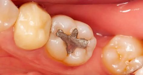 Amalgam vs. Composite Fillings: Which is Best for You? - Dentaly.org Composite Fillings, Amalgam Fillings, Cavity Filling, Dental Advertising, Tooth Filling, Dental Fillings, First Tooth, World Health Organization, Healthy Teeth