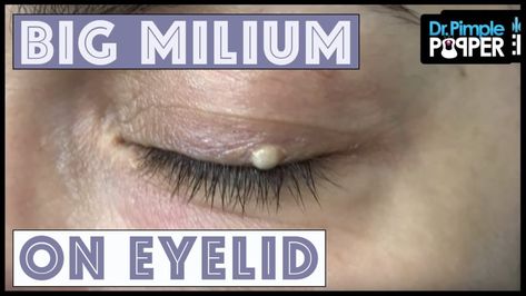 One Big Milium with Dr Pimple Popper - Pimple Popping Videos Pimple On Eyelid, Big Zits, Head Pimples, Pimple Popper Tool, Cystic Pimple, Pore Strips, Chemical Peel, How To Get Rid Of Acne, Improve Skin Texture