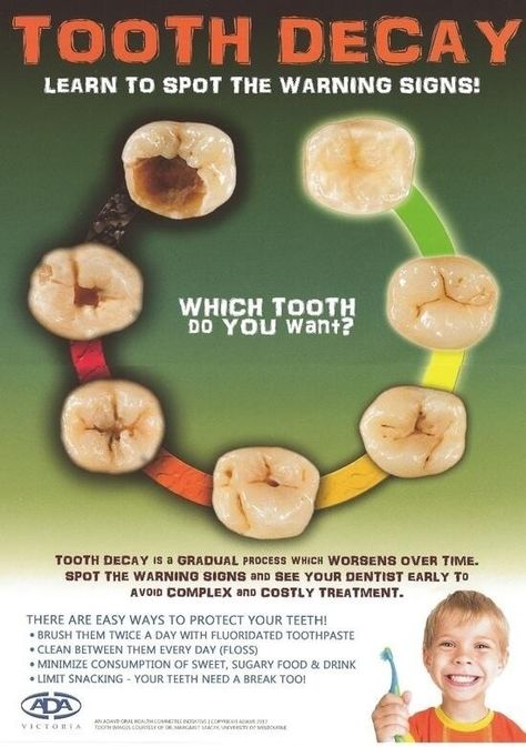 A diagram showing the stages of formation of cavity. Dental Quotes, Dental World, Dental Posts, Dental Hygiene School, Dental Fun, Dental Facts, Dental Life, Dental Marketing, Dental Humor