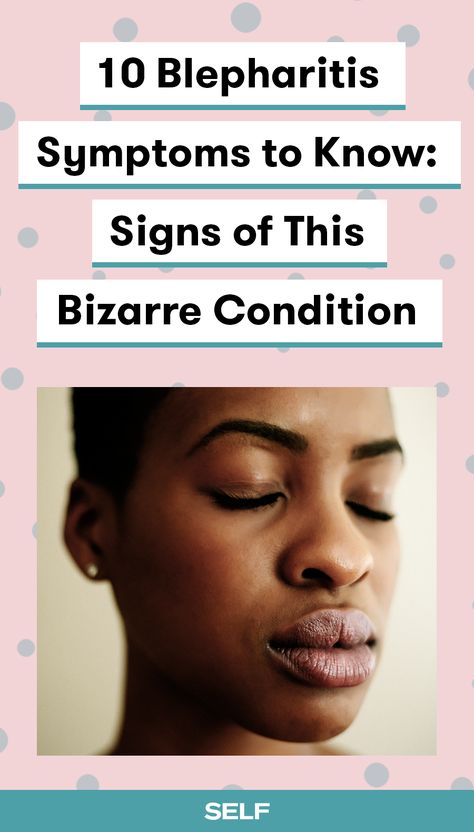 Blepharitis is a bizarre eyelid inflammation that can happen for a variety of reasons, like a bacterial infection on your eyelids, an allergic reaction to your makeup, or a malfunctioning of the glands that pump oil into your tear film to help your eyes stay moisturized. Here's everything you need to know about the condition and how it can affect your vision. Bump On Eyelid, Swollen Eyelids Remedy, Itchy Eyelids, Swollen Eyelid, Dry Eyelids, Drooping Eyelids, Swollen Eyes, Excess Skin, Sore Eyes