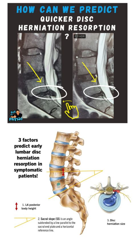 This is a question that many of my patients are asking 👇 Can we predict LDH lumbar disc herniation resorption in symptomatic patients ? 🤔 In this study, Ninety-three patients diagnosed with acute symptomatic LDH were included. They have concluded Early resorption can occur in 24.7% of LDH patients. These 3 factors were found to be most predictive of early resorption (p<.05). 👇 1- A greater L4 posterior vertebral height (coeff:14.58), 2- A greater sacral slope (coeff:0.12), 3- A greater herniated volume (coeff:0.013) at baseline If you’re having back pain, don’t panic. We can help 😃🙌 For enquiry email me on rehab@dublinsportsinjuryclinic.com or Call me on 00353979276712 Follow @bobthephysio & @dublin_sports_injury_clinic #pain #MRI #healthfacts #physicaltherapy #physica Disc Herniation, Lumbar Disc, Disk Herniation, Spine Health, Sports Injury, Health Facts, Physical Therapy, Back Pain, Call Me