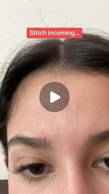 Matt Randon 🧩 on Instagram: "HOW TO GET RID OF BUMPS AND TEXTURE!😱 (follow for more!💗)  #acneproblems #acnetips #acnefree #blackhead #skincarecommunity #skincareaddict #skincareroutines #skincareobsessed #skincareproduct" How To Get Rid Of Tiny Bumps On Forehead, How To Get Rid Of Bumps On Forehead, How To Get Rid Of Forehead Bumps, How To Get Rid Of Tiny Bumps On Face, Tiny Bumps On Forehead, Matt Randon, Forehead Bumps, Acne Free, Blackheads