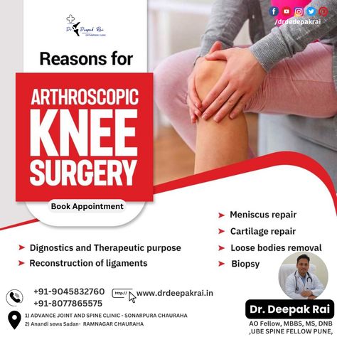 𝑨𝑹𝑻𝑯𝑹𝑶𝑺𝑪𝑶𝑷𝑰𝑪 𝑲𝑵𝑬𝑬 𝑺𝑼𝑹𝑮𝑬𝑹𝒀 : Here are some common reasons why arthroscopic knee surgery may be performed: Meniscus Tears: The meniscus is a rubbery, C-shaped cartilage in the knee that can tear due to injury or degeneration. Arthroscopy can trim or repair torn meniscus tissue. ACL (Anterior Cruciate Ligament) Reconstruction: Athletes often suffer ACL tears, which can be reconstructed using arthroscopic techniques. This procedure involves replacing the damaged ligament wit Arthroscopic Knee Surgery, Orthopedic Doctor, Anterior Cruciate Ligament, Acl Tear, Cruciate Ligament, Knee Surgery, Varanasi, Surgery, Repair