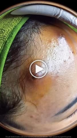 pimple popping and blackheads removal on face Dr Pimple Poppìng Videos, Oddly Satisfying Videos Pimples, Ear Pimple Poppìng Videos, Big Pimple Poppìng Videos, Pimple Poppìng Videos New, Popping Pimples Videos, Cystic Pimple Pop, Pimple Poppìng Videos Satisfying, Pore Video