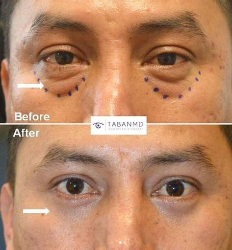 Belfaroplasty Eyes, Eye Bag Surgery, 35 Year Old Man, Baggy Eyes, Dry Skin Patches, Skin Care Wrinkles, Eye Lift, Under Eye Bags, Happy Skin