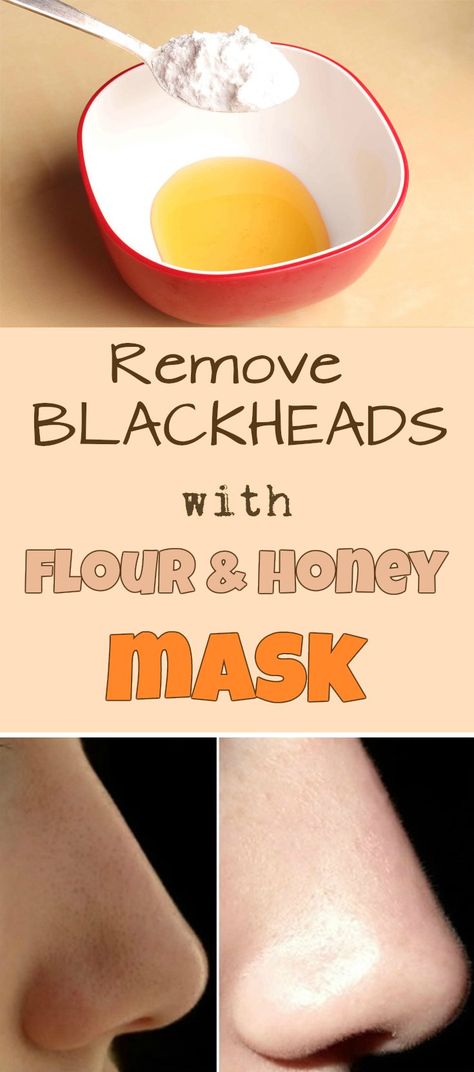 Remove blackheads with flour and honey mask - Beauty Area Face Mask For Blackheads, Blackhead Remedies, Blackhead Mask, Black Heads, Honey Mask, Remove Blackheads, Face Pack, Get Rid Of Blackheads, Homemade Face Masks