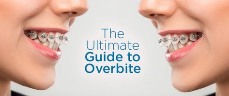 People are sometimes unaware of the difference between overjet and overbite, or are commonly confused about these two different types of dental malocclusions. Fix Overbite, Dental Check Up, Cleft Palate, Gum Recession, Jaw Pain, Cosmetic Dentistry, Dental Care, Headache, Fix It