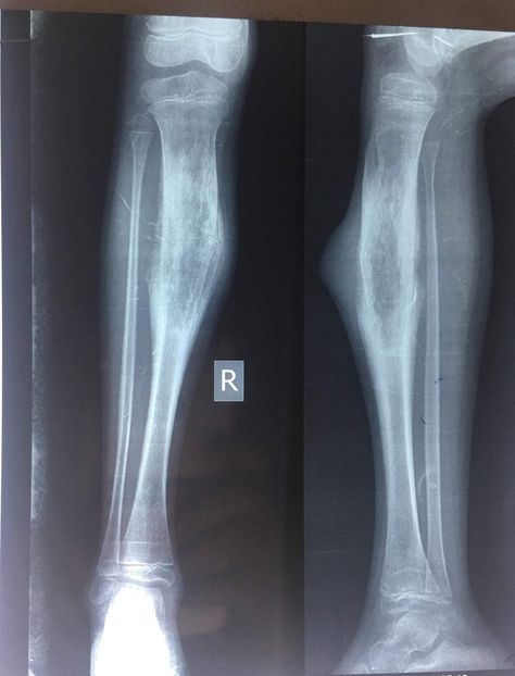 Adolescent x ray leg AP & LATERAL views showing large expansile sclerotic lesion noted in the diaphysis of tibia with widening of bone along with multilayered elevation of periosteum and cortical break is seen. Soft tissue component noted.. likely Ewing's sarcoma. Osteosarcoma , lymphoma Hospital Admit, Walter Boys, Plant Styling, Imagenes Mary Kay, Hospital Admit Hand Pics, Oil Platform, Leg Bones, Delivery Pictures, Bone Diseases