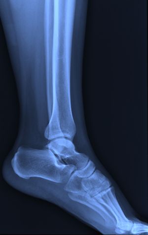 Ankle Injuries From Bicycle or Motorcycle Accidents Pink Violin, Motorcycle Accidents, Ankle Fracture, Ankle Injuries, Bike Accident, Motion Energy, Patient Satisfaction, Bicycle Accident, Accident Injury