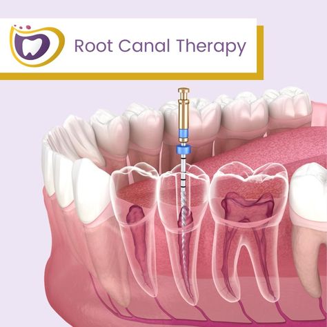 Root canal therapy is needed when the nerve of a tooth is affected by decay or infection. In order to save the tooth, the pulp (the living tissue inside the tooth), nerves, bacteria, and any decay are all removed, with the resulting space getting filled with special, medicated dental materials, which restore the tooth to its full function! If your tooth can be saved, why not go for it? Visit our website at https://www.cdsmile.com/ or give us a call at (707) 741-6090 today! . . . . #dentistry #de Filling Teeth, Toddler Tooth Decay, Dental Materials, Tooth Filling, Implant Dentist, Wisdom Tooth Extraction, Teeth Implants, The Nerve, Tooth Sensitivity