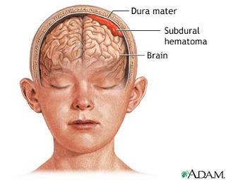 Increased Intracranial Pressure - RNpedia.com Intercranial Hypertension, Brain Bleed, Circle Of Willis, Medical Diagrams, Internal Carotid Artery, Side Of Face, Intracranial Pressure, Heart Location, Nursing Cheat