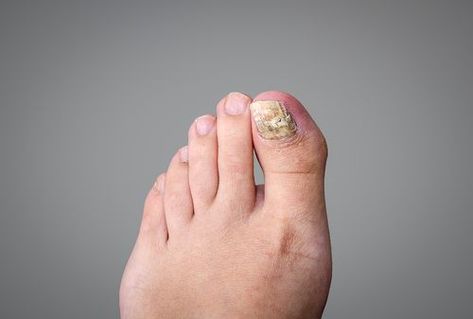 fungal infection on toe nail Treating Toenail Fungus, Fungal Infection Remedies, Toenail Fungal Infection, Nail Falling Off, Nail Remedies, Toenail Fungus Remedies, Nail Infection, Fungal Nail, Nails Today