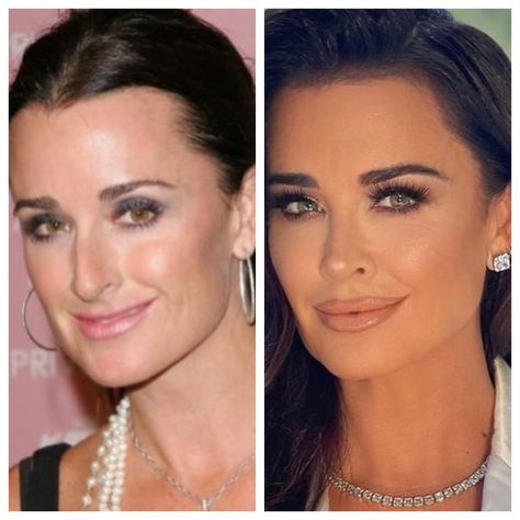 Kyle Richards Plastic Surgery, Plastic Surgery Gone Wrong, Celebrity Plastic Surgery, Kyle Richards, The Kardashians, Beauty Guru, Medical History, Empowering Women, Cartoon Profile Pics