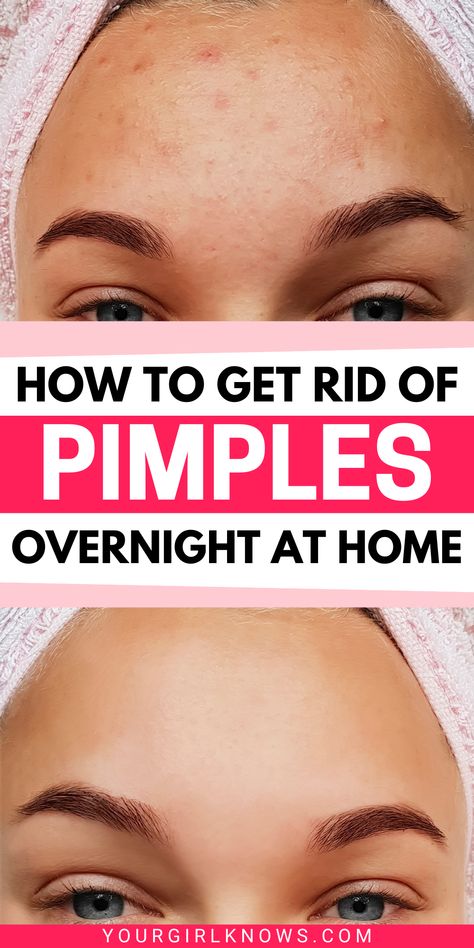 HOW TO GET RID OF PIMPLES OVERNIGHT AT HOME | DIY ACNE TREATMENTS | YOURGIRLKNOWS #acne #pimples #pimplesremedies #acneremedies #skincarediy. https://whispers-in-the-wind.com/combatting-pimples-under-the-skin-expert-tips-and-product-recommendations/?154 Get Rid Of Acne Fast, Get Rid Of Pimples Overnight, Rid Of Pimples Overnight, Rid Of Acne Overnight, Get Rid Of Acne Overnight, Get Rid Of Pimples, Blind Pimple, Rid Of Pimples, Forehead Acne