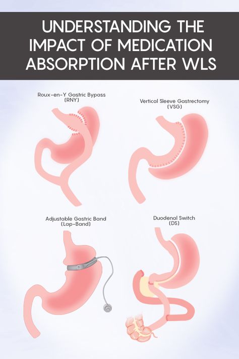 Duodenal Switch Surgery, Gastric Bypass Revision Surgery, Wls Before And After, Modified Duodenal Switch, Sadi-s Surgery, Bariatric Portions, Sleeve Surgery Before And After, No Chew Foods After Surgery Bariatric, Gastric Bypass Before And After