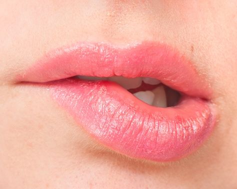 The Best Way to Soothe Sunburned Lips  #beauty #tips #skin #hair #body #care #women Sunburnt Lips, Sunburn Blisters, Blister Remedies, Blister On Lip, Sunburned Lips, Home Remedies For Sunburn, How To Treat Sunburn, Sunburn Remedies, Upper Lip Hair