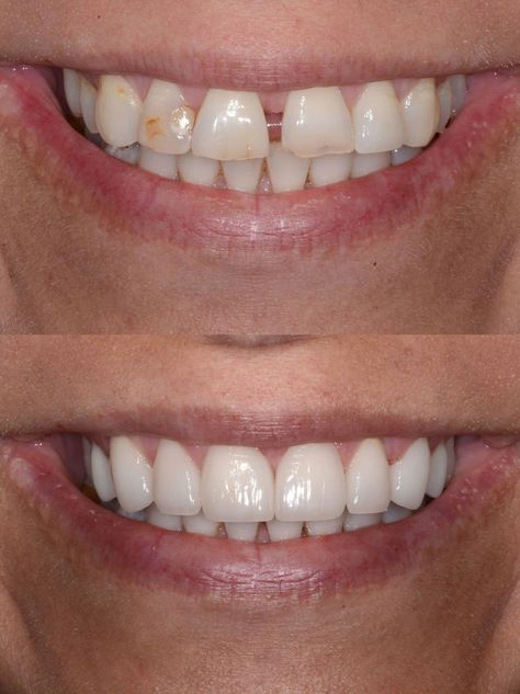 Don't like the space between your front teeth?   Dr. Hulse can fix that with several different methods. Smile Tips, Space Between Teeth, Dental Business Cards, Dental Posters, Unwanted Hair Growth, Dental Fun, Medical Animation, Loose Tooth, Barbell Workout