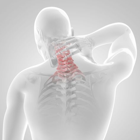 Cervical disc replacement, aka total disc replacement or disc arthroplasty is a new type of spine surgery that may help preserve motion in your neck. Cervical Disc, Invisible Disease, Craniosacral Therapy, Sjogrens Syndrome, Neck Exercises, Cervical Spine, Spine Surgery, Patient Experience, Invisible Illness