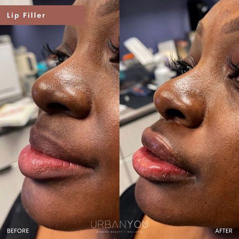 Lip Filler | Before and After 0.5 Ml Lip Filler Before And After, Aesthetic Procedures, Lip Flip, Face Fillers, Lip Filler, Lip Injections, Lip Fillers, Self Acceptance, Med Spa