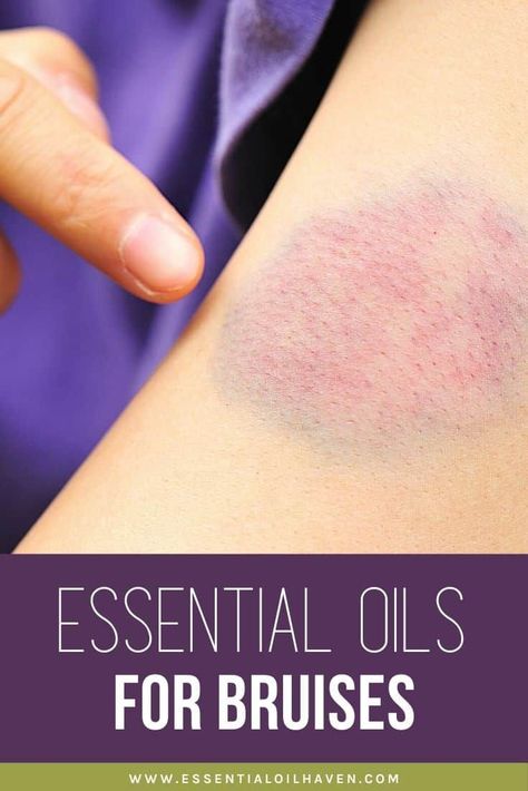 This practical guide on the best essential oils for bruises will help you get started. Learn about the 9 best oils to help your bruise heal faster and relieve the pain associated with your injury. #essentialoils #essentialoilhaven Essential Oil For Bruising, Yarrow Essential Oil, Oils For Scars, Turmeric Essential Oil, Soft Tissue Injury, Essential Oils For Pain, Sick Remedies, Frankincense Essential Oil, Doterra Oils