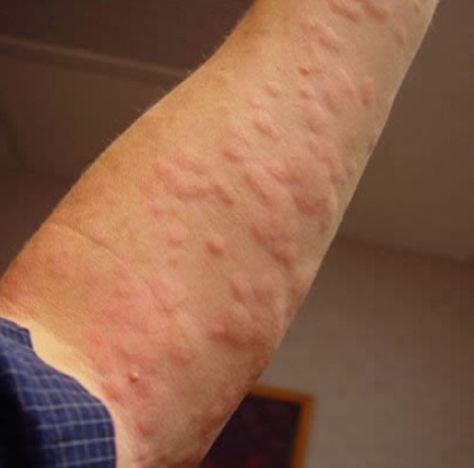 Allergic Reaction Rash, Hives Rash, Hives Remedies, Allergy Rash, Chronic Hives, Sun Allergy, Home Remedies For Skin, Skin Allergies, Allergic Reaction