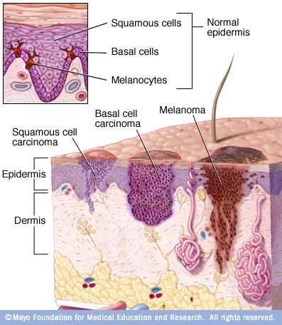 Skin Symptoms, Skin Anatomy, Basal Cell, Squamous Cell, Glow Skin, Skin Disorders, Medical Knowledge, Mayo Clinic, Anatomy And Physiology