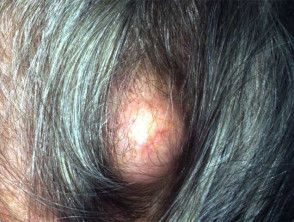 Pilar cyst. Trichilemmal cyst | DermNet Bump On Head, Infected Hair Follicle, Hearing Problems, Severe Headache, Skin Disorders, Things Under A Microscope, Roots Hair, Ingrown Hair, Hair Follicle