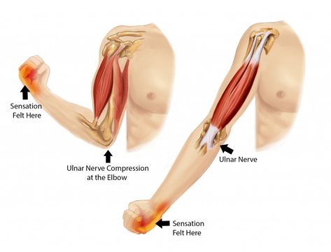 Cubital Tunnel Syndrome: Cubital tunnel syndrome is a condition that affects the ulnar nerve where it passes the inside edge of the elbow. Cubital tunnel syndrome is the second common compression neuropathy in the upper extremity. Numbness and tingling sensation in the hand and fingers are common symptoms of cubital tunnel syndrome.  Advanced disease is … Carpal Tunnel Exercises, Cubital Tunnel Syndrome, Nerve Relief, Carpal Tunnel Relief, Nerve Problems, Ulnar Nerve, Forearm Muscles, Genetic Algorithm, Muscle Atrophy