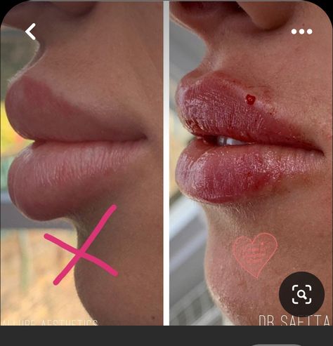 Bad Lip Filler, 0.5 Ml Lip Filler Before And After, Lips Fillers, Plan Furniture, Lips Shape, Lips Inspiration, Face Fillers, Botox Lips, Ginza Tokyo