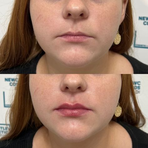 Lip Filler On Small Lips, Dermal Fillers Lips, Lip Flip, Cosmetic Injectables, Newcastle Nsw, Small Lips, Injectables Fillers, Cosmetic Dermatology, Lip Filler