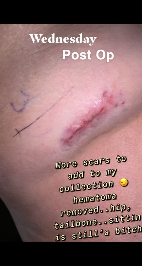 Hematoma drainage absecess/ hairline hip fracture, once pre op release from dr. Physical therapy ordered😏 Hip Fracture, Post Op, Surgery Recovery, Physical Therapy, Surgery, Physics