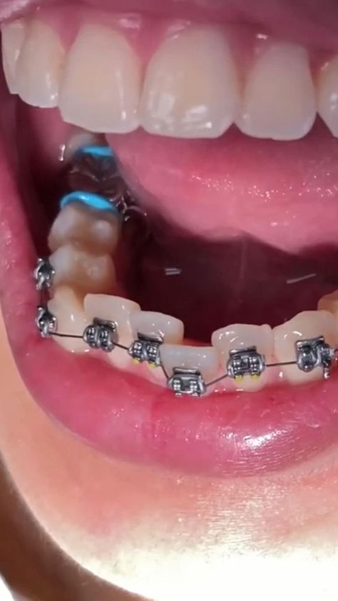 Amazing braces transformation! [Video] | Getting braces, Braces transformation, Braces tips Braces Transformation, Dental Wallpaper, Braces Tips, Getting Braces, Braces Off, Orthodontic Appliances, Dental Videos, Men Skin Care Routine, Braces Colors