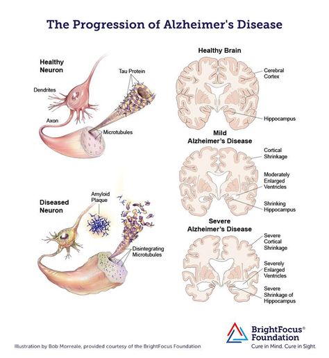 One of the hallmarks of Alzheimer's disease is the accumulation of amyloid plaques between nerve cells (neurons) in the brain. Brain Nerves, Brain Diseases, Alzheimers Awareness, Brain Tissue, The Human Brain, Nerve Cell, Adrenal Fatigue, Medical Illustration, Human Brain