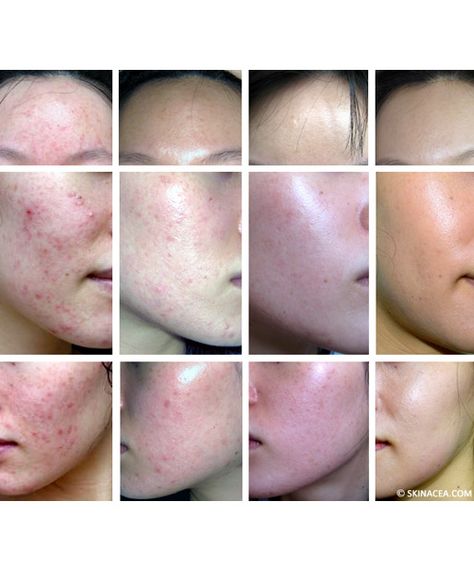 I Spent Thousands Battling Hormonal Acne, and a $20 Regimen Cured It | Through a four-year trial-and-error method, I finally found what keeps my acne under control. Chest Acne, Post Acne Marks, Natural Acne, Severe Acne, Hormonal Acne, Beauty Remedies, Acne Remedies, Skin Remedies, How To Get Rid Of Acne