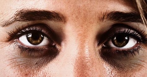 Many people have dark circles under their eyes. In this article, we look at possible causes and home remedies for dark circles under the eyes. Dark Circle Remedies, Dark Eye Circles, Remove Dark Circles, Dark Circles Under Eyes, Reduce Dark Circles, Dark Circle, Eye Circles, Undereye Circles, Tired Eyes