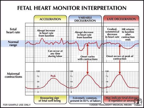 OB Fetal Heart Tone Monitoring Decelerations-Learn how to view, detect, and monitor fetal heart tones by the monitoring decelerations sheet. Description from pinterest.com. I searched for this on bing.com/images Ob Emergencies, Fetal Heart Monitoring, Fetal Monitoring, Fetal Heart Rate, Nurse Things, Newborn Nursing, Contraception Methods, Child Nursing, Student Midwife