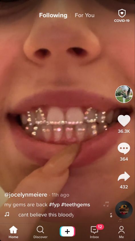 Teeth Gems Retainer, Gems On Invisalign, Bottom Tooth Gems Ideas, Tooth Gems Front Teeth, Cute Tooth Gems Ideas, Tooth Gem Studio, Gem Retainer, Retainers With Gems, Bedazzled Retainer