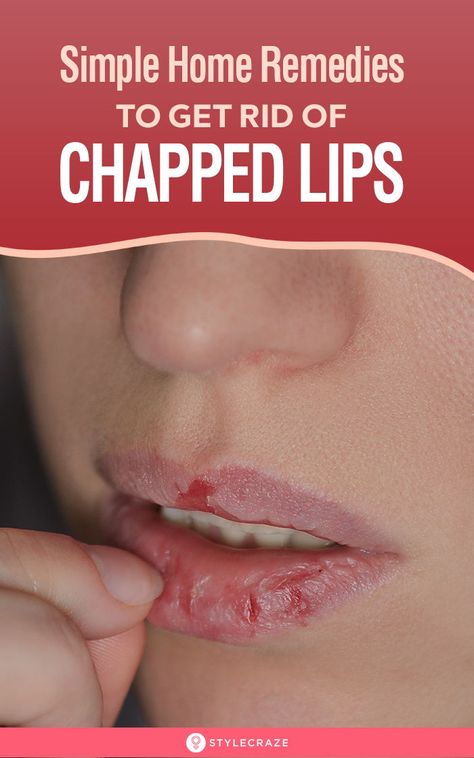 10 Simple Home Remedies To Get Rid Of Chapped Lips: Water is an essential part of any beauty regimen. It helps to keep your body and skin well hydrated. No matter how many remedies or lip balms you use, if you do not drink enough water, your chapped lips are going to keep coming back. So, first and foremost, drink plenty of water during the day and use the remedies given in this article for faster results. #Beauty #BeautyTips #ChappedLips #LipCare #Remedies #HomeRemedies #NaturalRemedies Chapped Lips Remedy, Drink Enough Water, Baby Lips, Cracked Lips, Drink Plenty Of Water, Health Vitamins, Natural Cough Remedies, Braut Make-up, Beauty Regimen