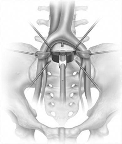 L5-S1 Degenerative Disc Disease. What Surgical Options Do I Have for Accessing the Anterior L5-S1 Interspace? L5 S1, Sciatic Nerve Pain Relief, Foot Reflexology Massage, Intervertebral Disc, Degenerative Disease, Spine Health, Spine Surgery, Nerve Pain Relief, Sciatic Nerve Pain