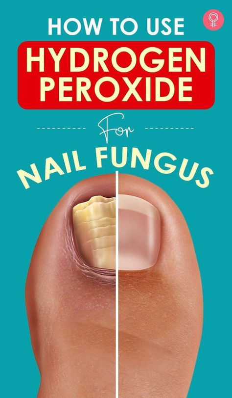 best nail fungal treatment Lettuce Storage, Fungal Infection Remedies, Toenail Health, Toenail Fungal Infection, Nail Remedies, Peroxide Uses, Nail Care Diy, Hydrogen Peroxide Uses, Toenail Fungus Remedies