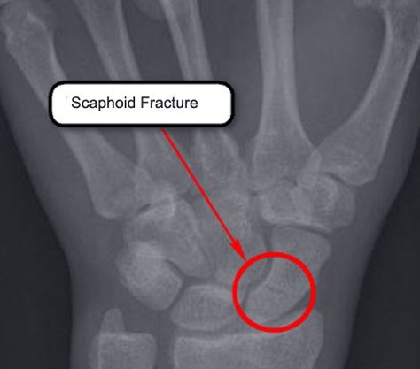 Scaphoid Fracture, Types Of Fractures, Radiology Student, Bone Fracture, Radiology Imaging, Bone Diseases, Medical Anatomy, Chiropractic Care, Medical Knowledge