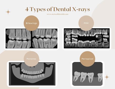 4 types of dental x-ray - bitewings, FMX, PAN, periapical Dental Xrays Tips, Periapical Radiograph, Dental Xrays, Dental Radiology, Dental Radiography, Dental Assistant Study Guide, Dental X Ray, Dental Assistant School, Dental Hygienist School