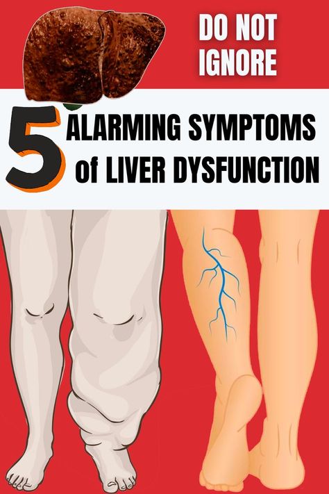 Liver failure occurs when your liver isn't working well enough to perform its functions (for example, manufacturing bile and ridding the body of harmful substances). Symptoms include nausea, loss of appetite, and blood in the stool. Loss Of Appetite, Liver Failure, Health Signs, Liver Support, Money Saving Plan, Cleanse Recipes, Liver Health, Brain Power, Alternative Health