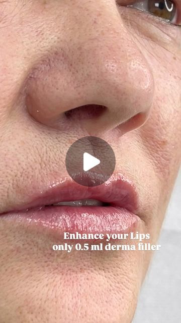 Nasimbeautylounge on Instagram: "🫦🫦 Engance your Lips with 
only 0.5 ml Lip filler 💋

💉Expert AESTHETIC PRACTITIONER 
✔️Permanent makeup artist 
✔️FULLY QUALIFIED & INSURED 

✔️CALL ON 07493311910
📍MANCHESTER

#lip #lipfiller #trending #naturalbeauty 
#instagram #reels #aesthetic" 0.5ml Lip Filler Before And After, 0.5 Ml Lip Filler Before And After, Instagram Reels Aesthetic, 1ml Lip Filler, Aesthetic Practitioner, Lip Filler, Beauty Clinic, Lip Fillers, Your Lips