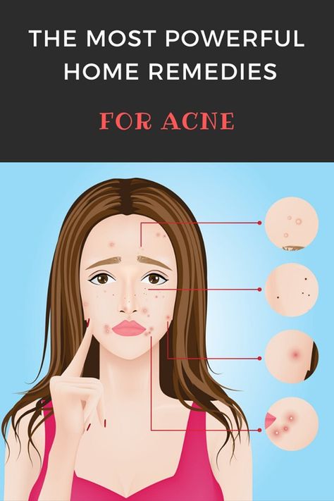 Remedies For Acne, Growing Healthy Hair, Ways To Be Healthier, Bad Acne, Pimples Remedies, Natural Acne Remedies, Home Remedies For Acne, Blemish Remover, Acne Solutions