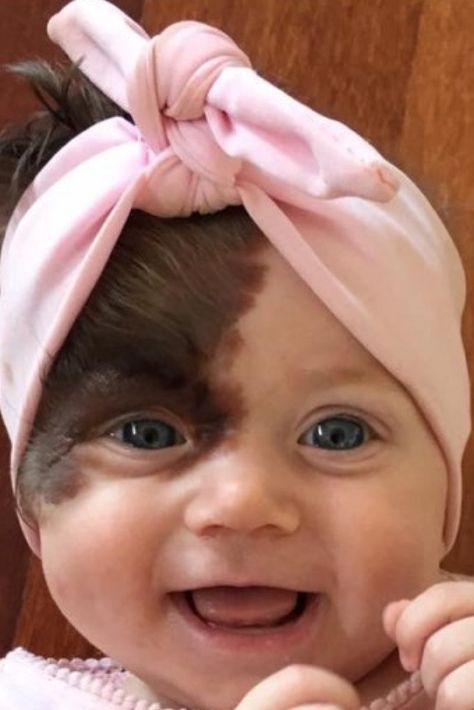 Baby Set To Undergo Seven Operations To Remove Hairy Birthmark Covering Quarter Of Her Face Face Birthmark, Birthmark On Face, Unique Eyes, Shotting Photo, Unique Faces, Makeup Eyes, Shooting Photo, Eyes Makeup, Baby Set